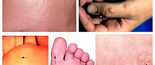 Бородавки. Информация для пациентов.